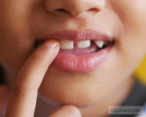 Missing and Impacted Teeth Management: Integrating Orthodontic Strategies With or Without Implants