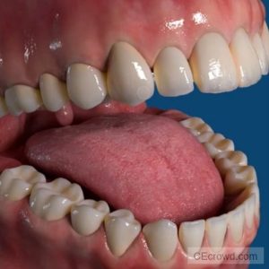 Oral Hard Tissue Disease and Home Care Management