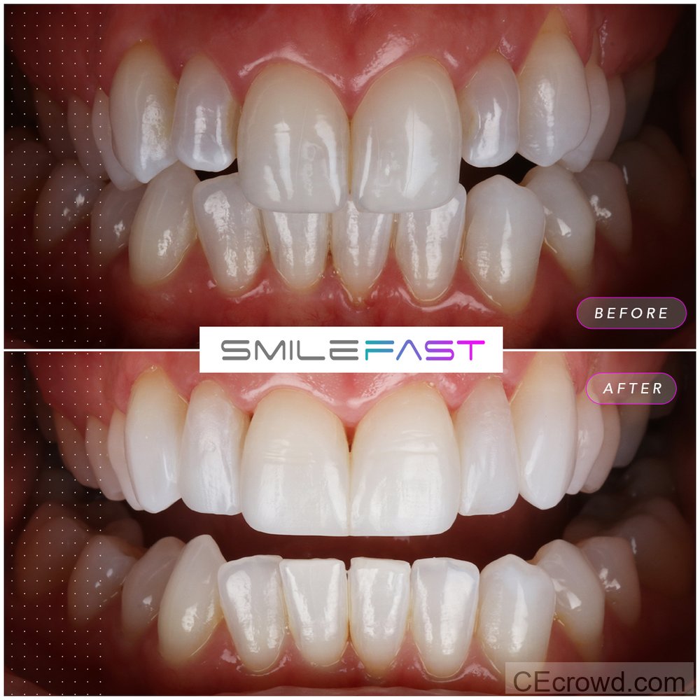 Smilefast Direct Training