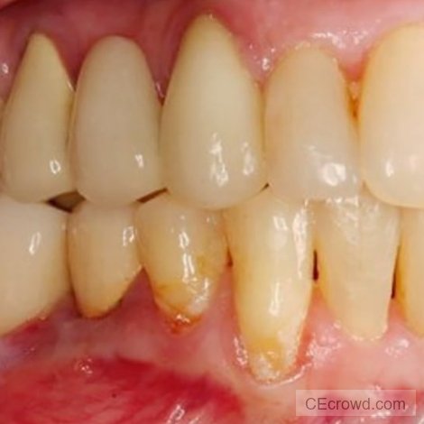 The 2018 AAP/EFP Classification of Periodontal & Peri-implant Diseases