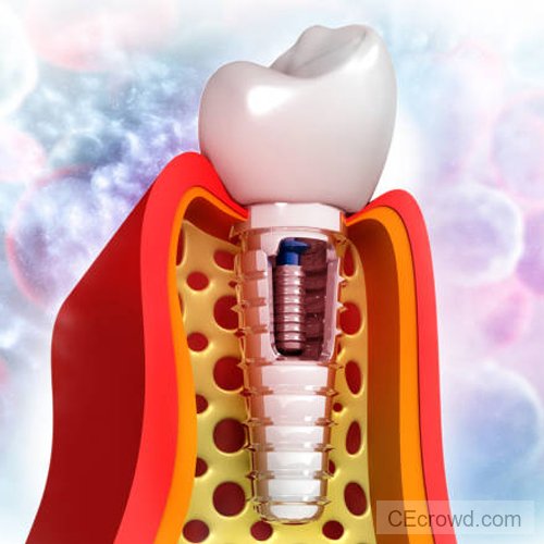 Adjunctive Implant Surface Decontamination for Treatment of Peri-Implant Disease