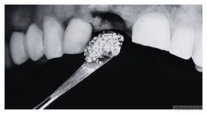 Bone Repair Approaches