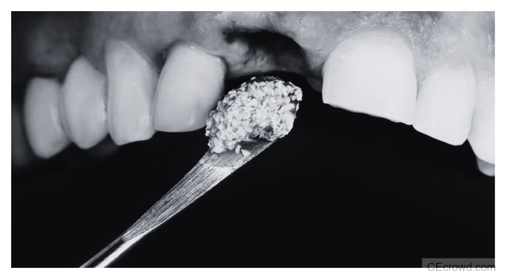 Bone Repair Approaches