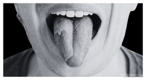 Burning Mouth Syndrome