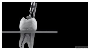 Endodontic Decision-Making for Complex Periradicular Bone Loss