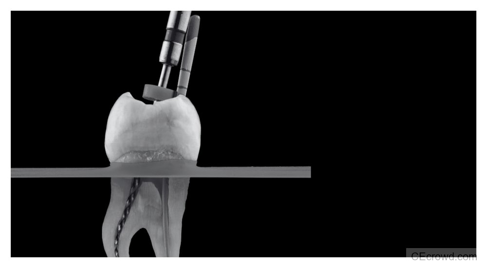 Endodontic Decision-Making for Complex Periradicular Bone Loss