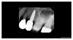 Implant Radiology: Myths and Facts