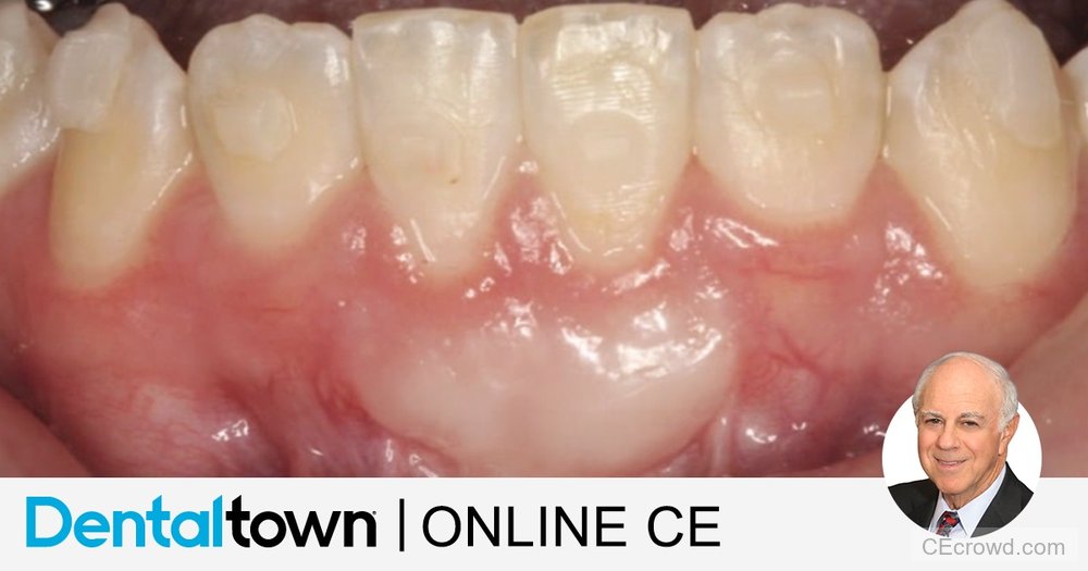 Improving Restorative Results with Soft Tissue Grafting by James Kohner, DDS