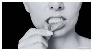 Infectious Stomatitis: Diagnosis, Management, and Interdisciplinary Care