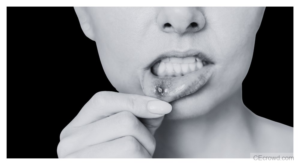 Infectious Stomatitis: Diagnosis, Management, and Interdisciplinary Care