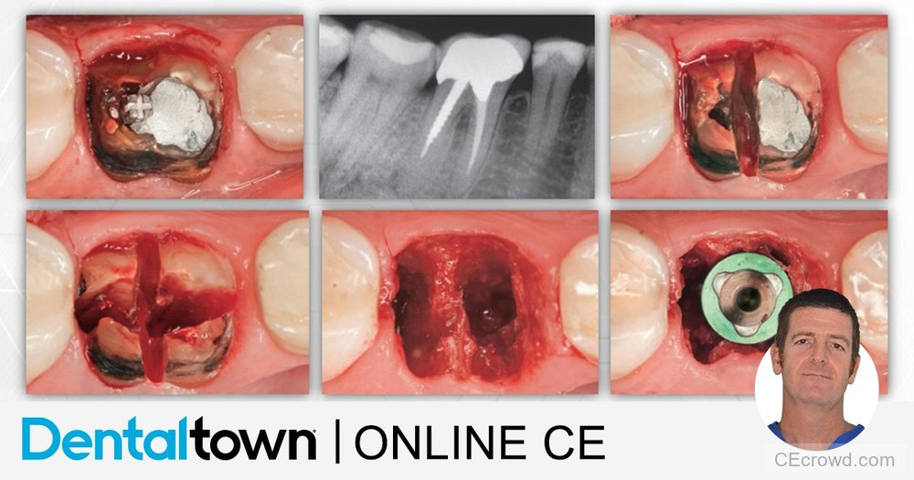 Management of complications during implant and periodontal surgeries by Dr. Giacomo Tarquini