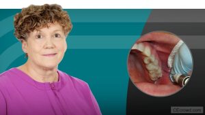 Maxillary Arch Techniques