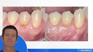 Mucogingival Aesthetic Surgery by Dr. Giacomo Tarquini