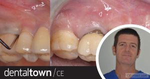 Osseous Resective Surgery by Dr. Giacomo Tarquini