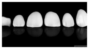 Ultraconservative Esthetic Dentistry: Balancing Function and Beauty